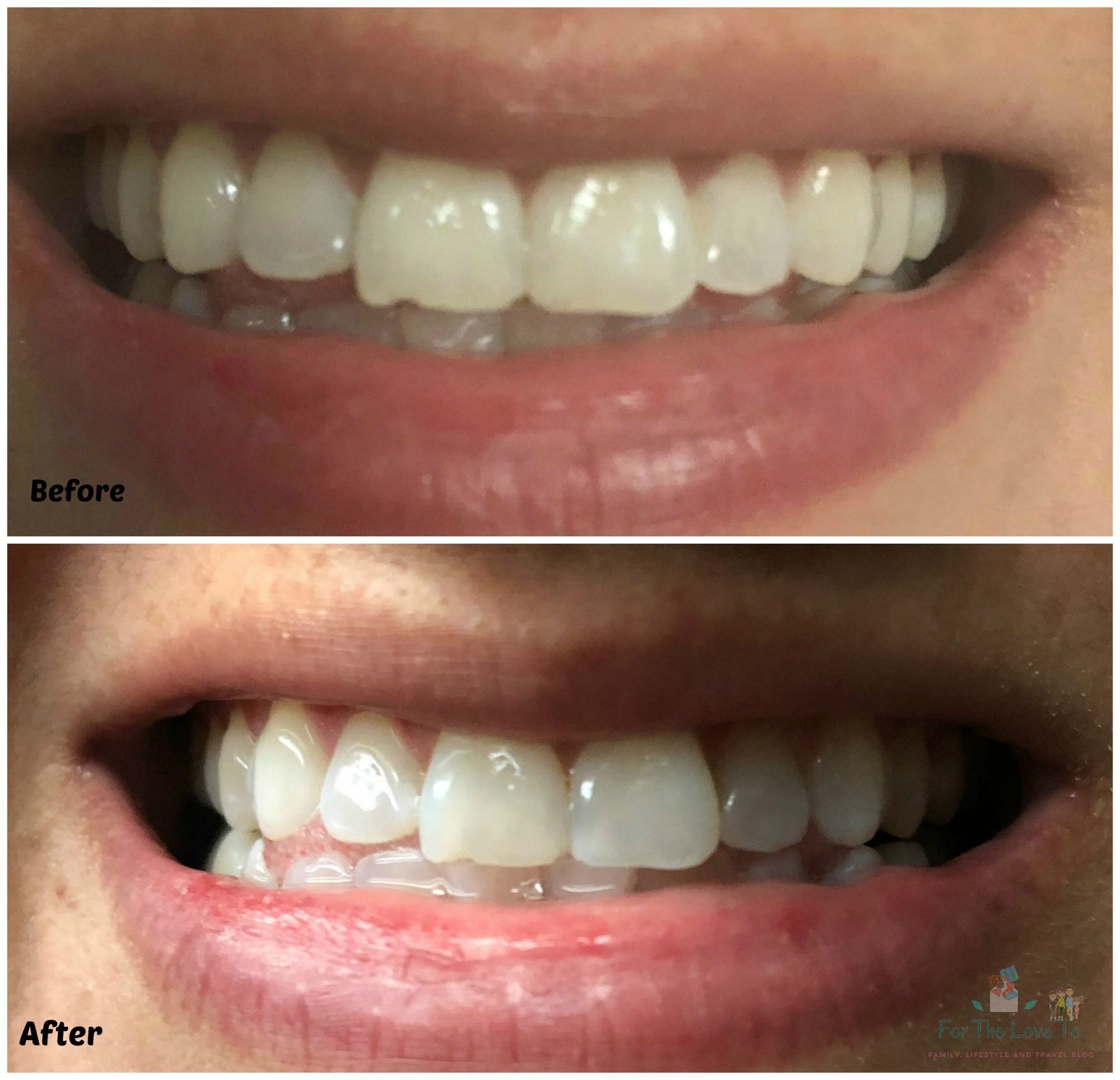How To Use Teeth Whitening