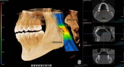 CBCT 3D imaging showing pediatric airway anatomy used to identify airway restrictions in children